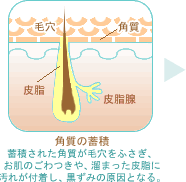 角質の蓄積・蓄積された角質が毛穴をふさぎ、お肌のごわつきや、溜まった皮脂に汚れを付着し、黒ずみの原因となる