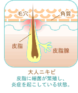 大人にきび・皮脂に細菌が繁殖し炎症をおこしている状態